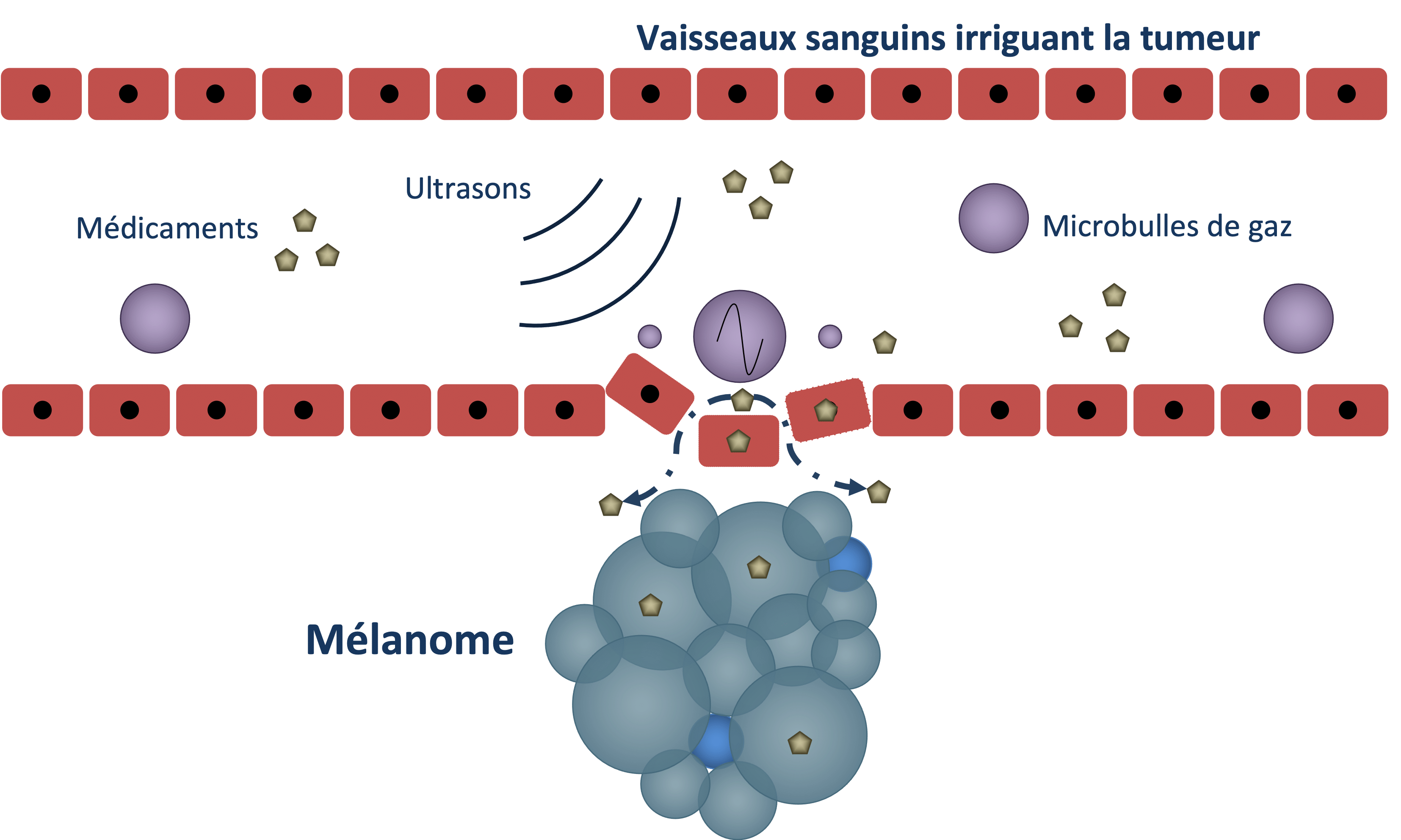 Délivrance de molécules thérapeutiques par sonoporation